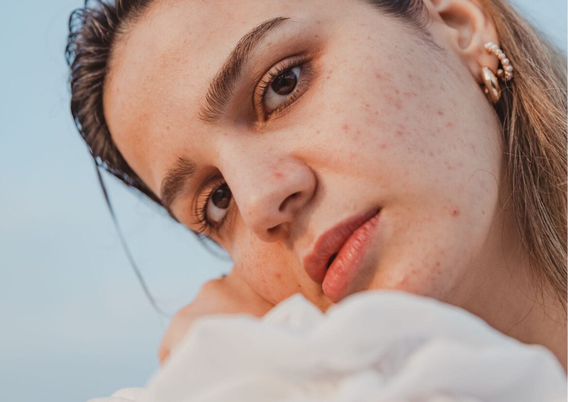 Absolème Les meilleurs astuces et conseils pour se débarrasser de l'acné naturellement