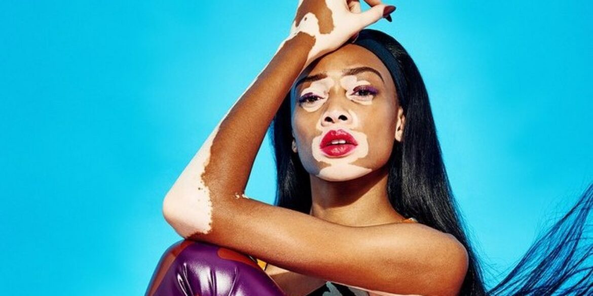 Absolème mode inclusive ces mannequins atypiques qui ont fait de leur différence une force